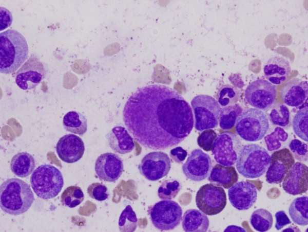 A small, hypolobated megakaryocyte (center of field) in a bone marrow aspirate, typically of chronic myelogenous leukemia. (Image courtesy of Difi Wu, shared with CC license via Wikimedia Commons)